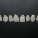 Carillas de porcelana
