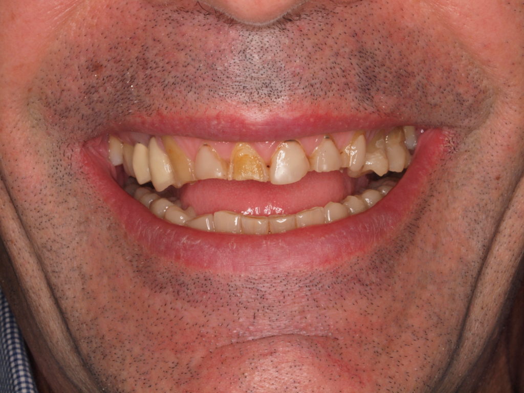 ANTES